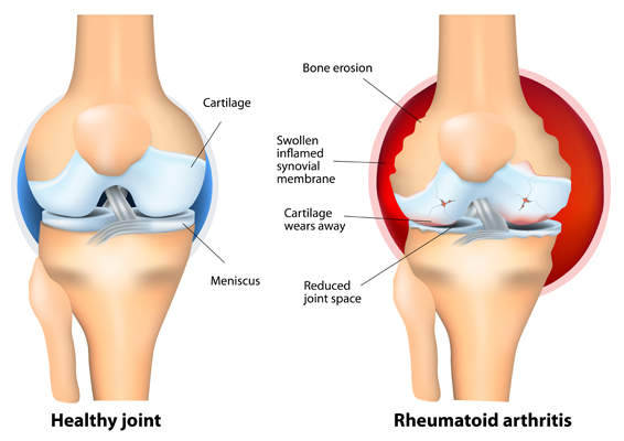 rheumatoid arthritis